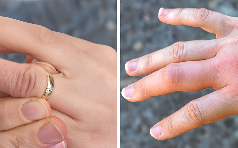 Ngón tay có vết hằn sâu do đeo nhẫn chật trong thời gian dài.