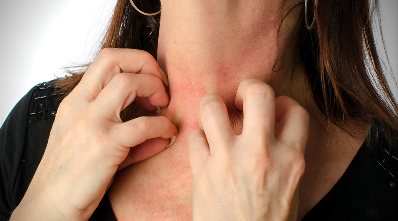 Hình ảnh bàn tay bị dị ứng, mẩn đỏ do đeo trang sức vàng trắng giả