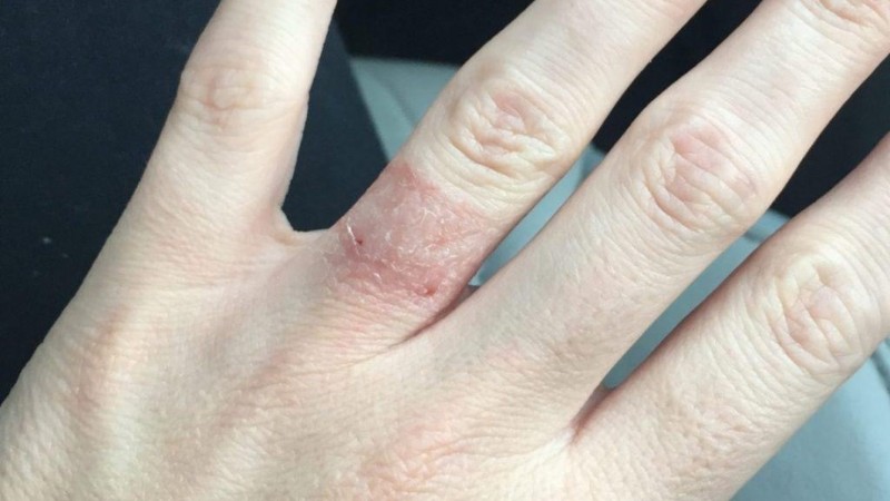 Đeo nhẫn bị chật có thể gây tổn thương và viêm da mẫn đỏ