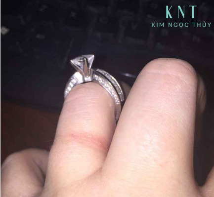 Kích ứng da do nhẫn cưới   