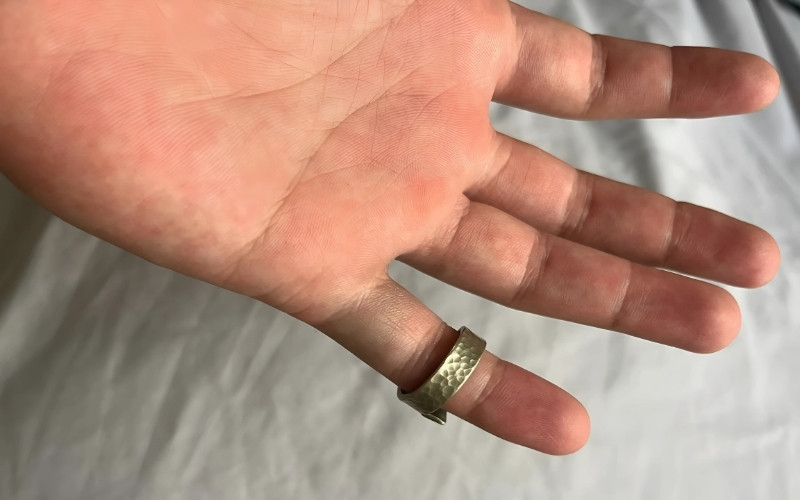 Hiện tượng này là vô hại đối với sức khỏe, đây đơn thuần là một vấn đề về mặt thẩm mỹ