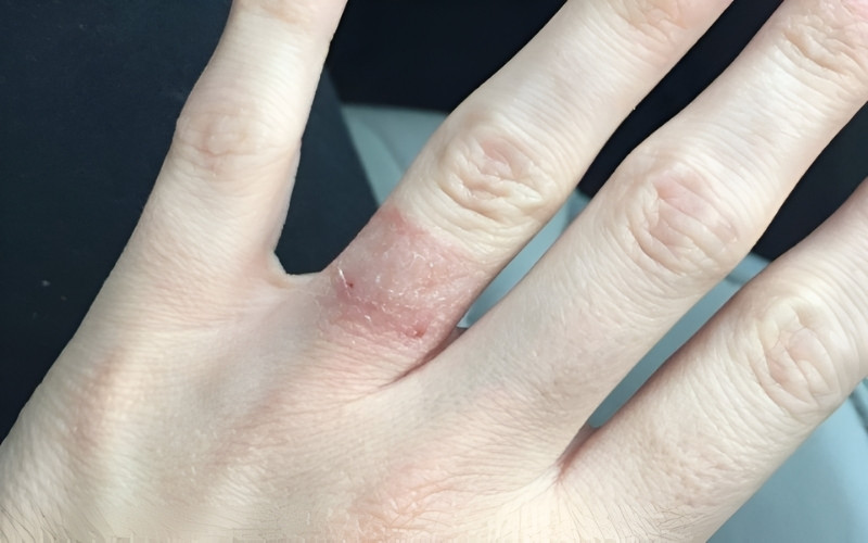 Dị ứng kim loại