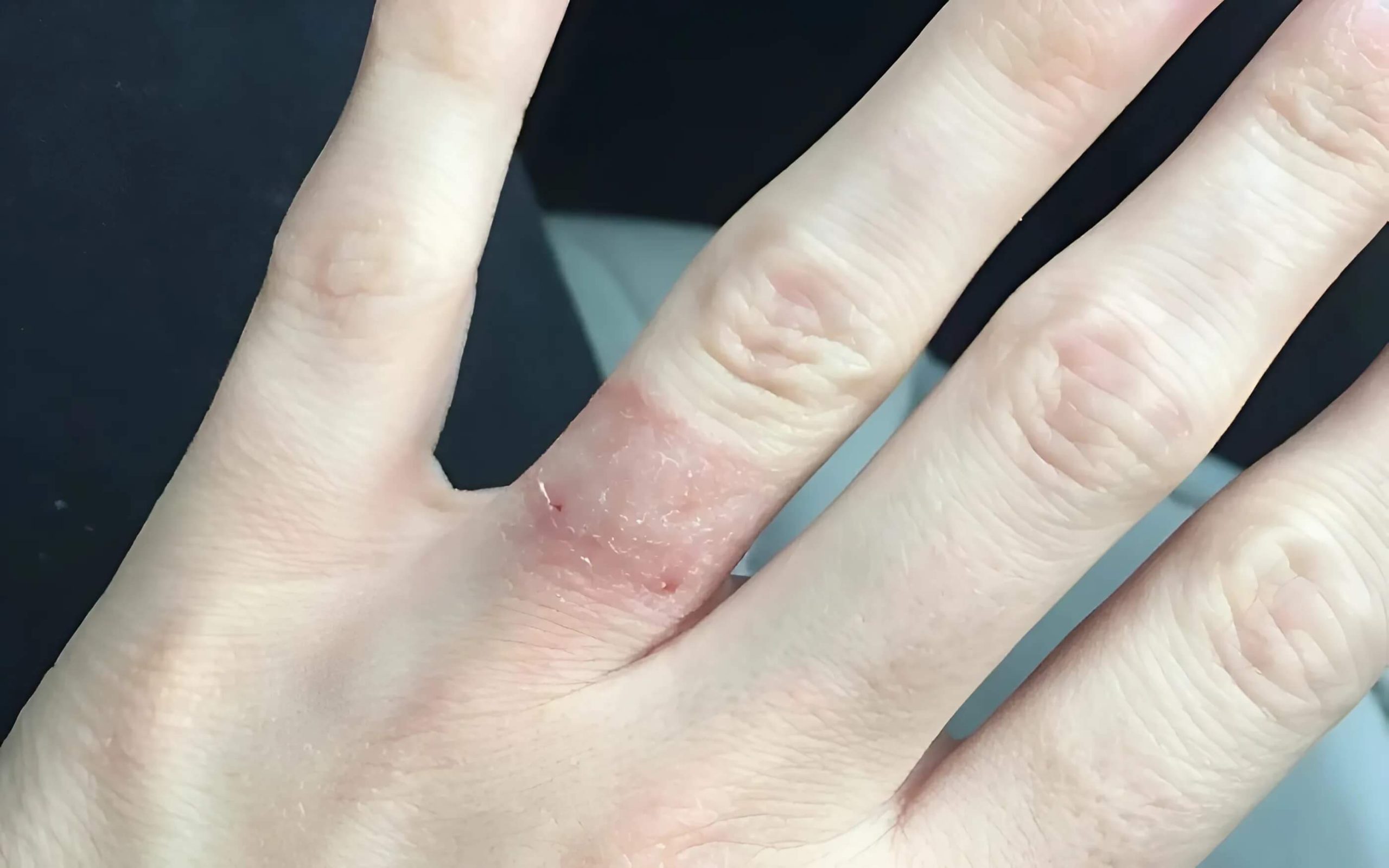 Một số người có thể bị dị ứng với các kim loại làm nhẫn gây ngứa, mẩn đỏ, sưng tấy, và đau nhức