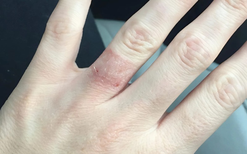 Nếu ngón tay có vết thương, cần can thiệp y tế để tháo nhẫn nhanh chóng